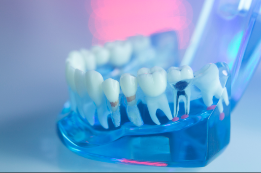 The Misconceptions Of Root Canal Auckland