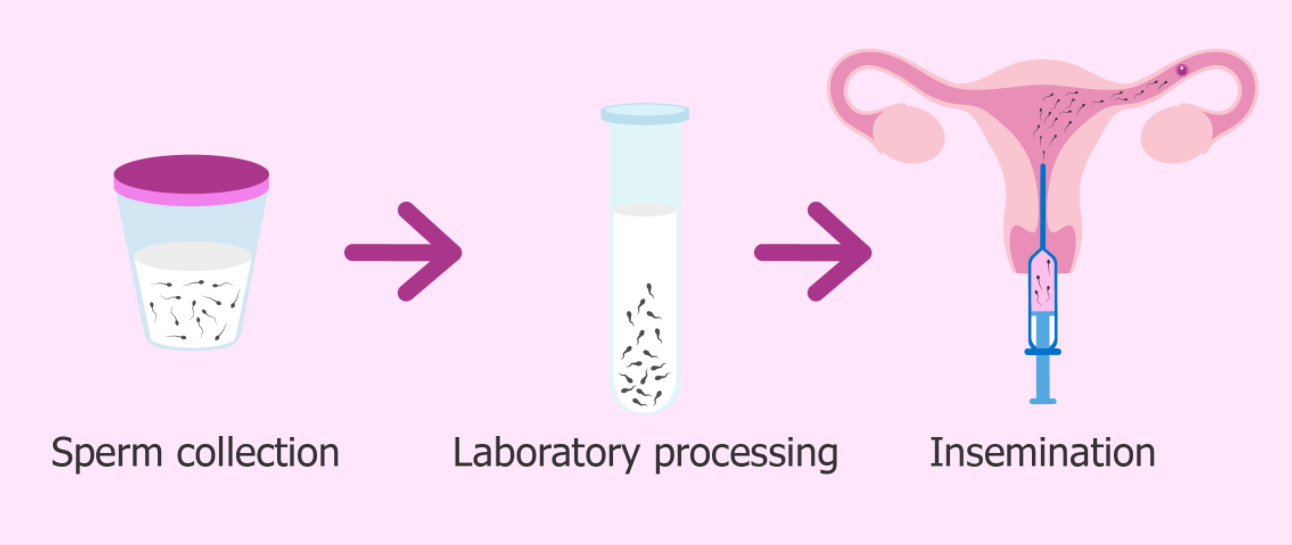 Artificial Insemination Can Be Used To Treat Infertility In Both Men And Women In Gauteng