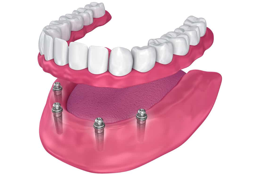 implant dentist Artarmon