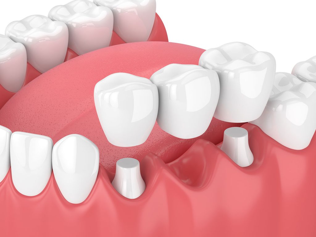 dental crowns Gold Coast
