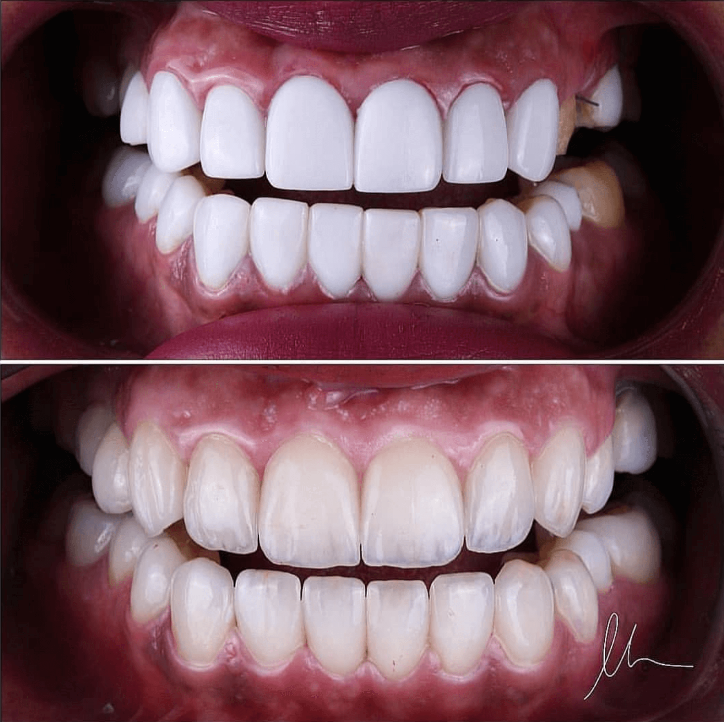 natural looking veneers