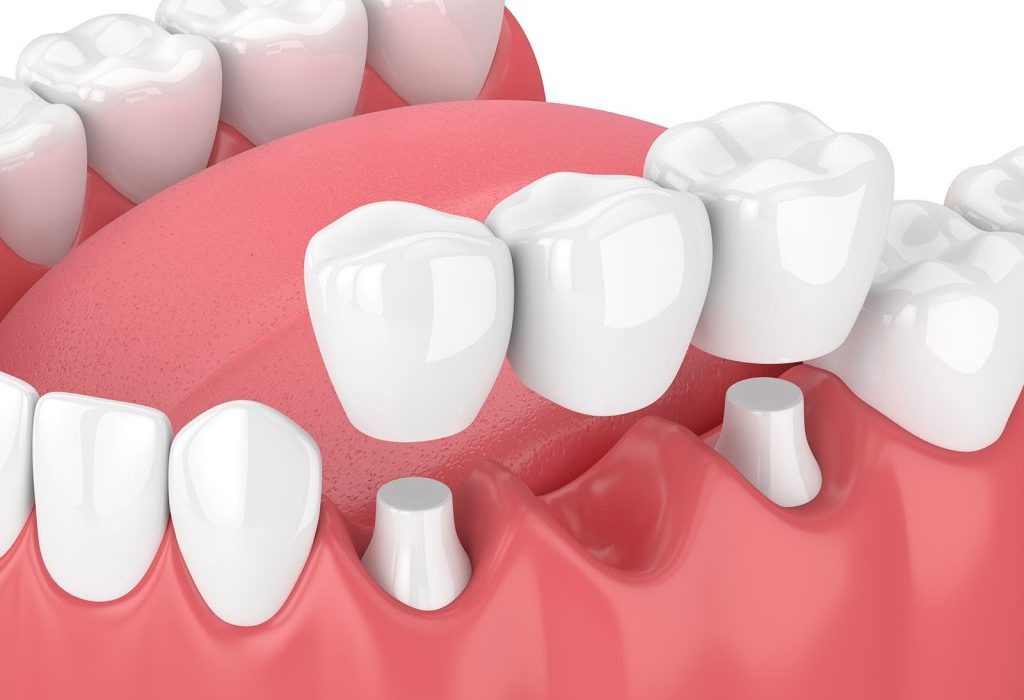 Dental Crowns Gold Coast Help You Enhance Your Smile and Confidence