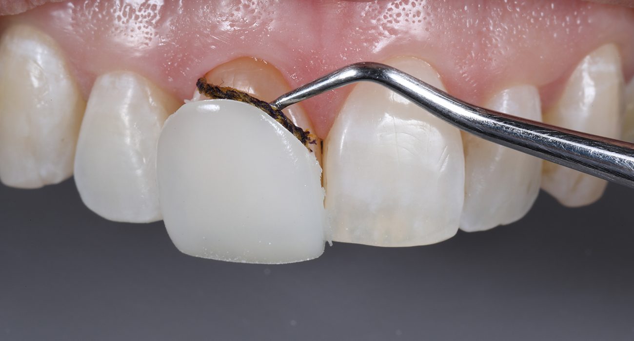 Veneer Composite Is the Key to Achieve a Beautiful Smile