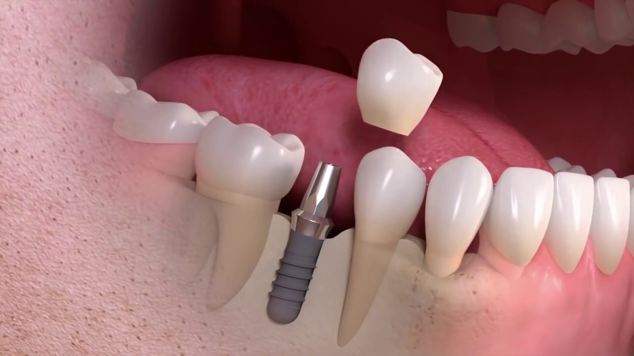 Full mouth dental implants Boca Raton