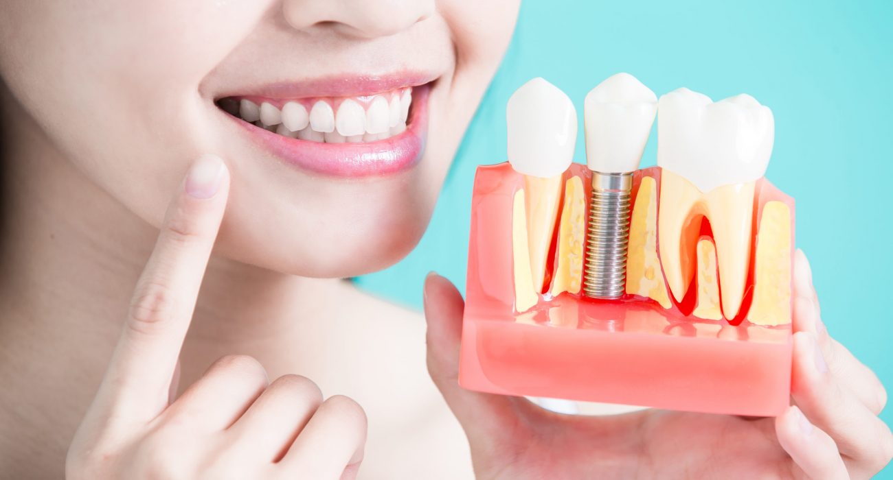 Finding A Dentist For Ottawa Teeth Whitening