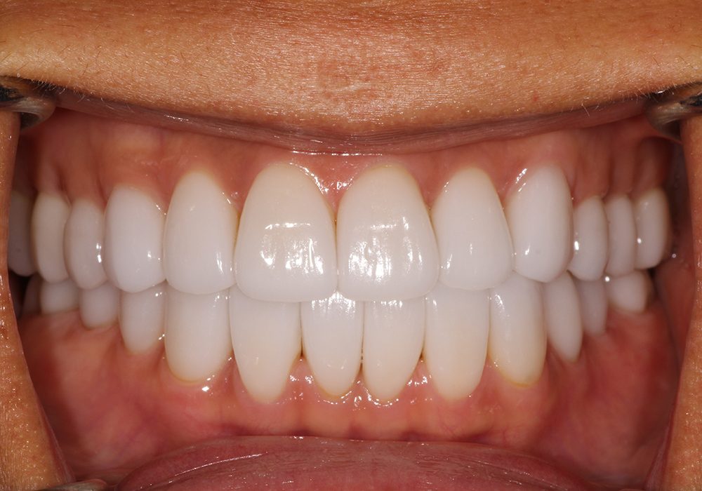 How Natural Looking Veneers Can Be Beneficial?