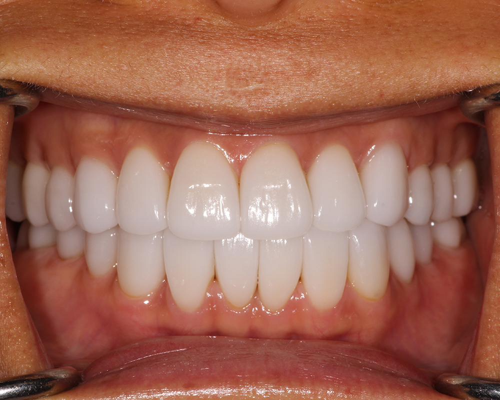 natural looking veneers
