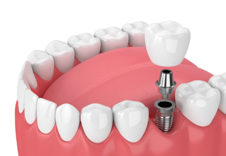 dental implants in Northern Rivers