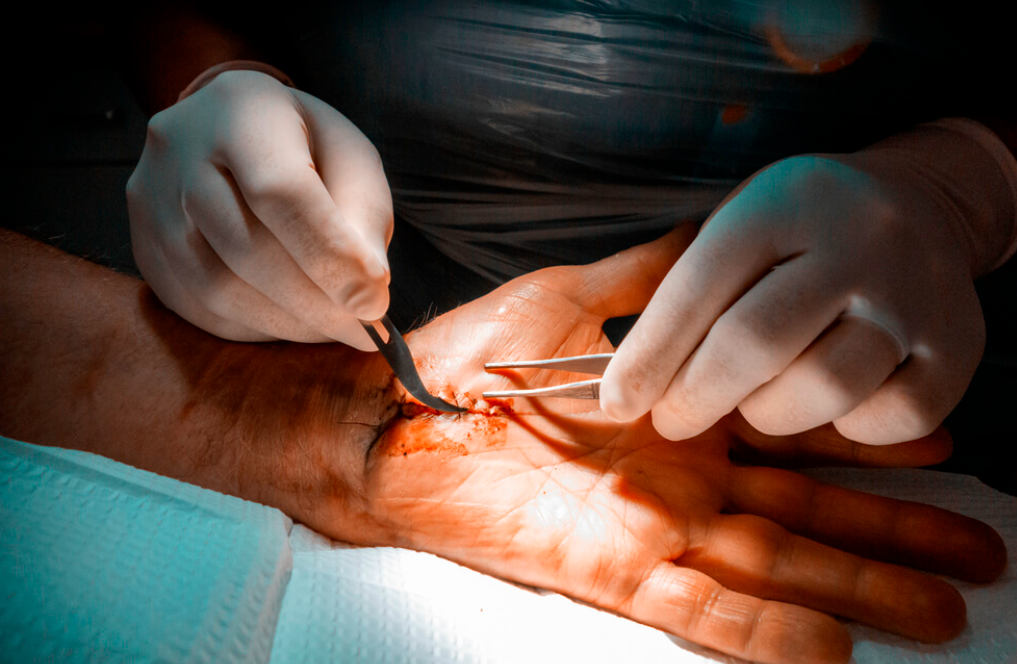 carpal tunnel treatment