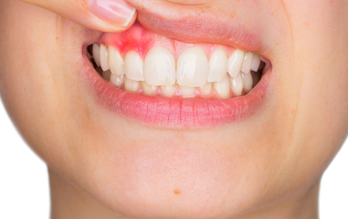 dental implant infection signs