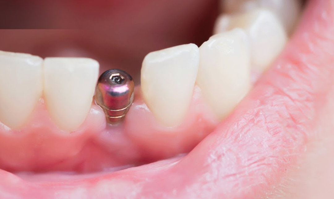 dental implant infection signs