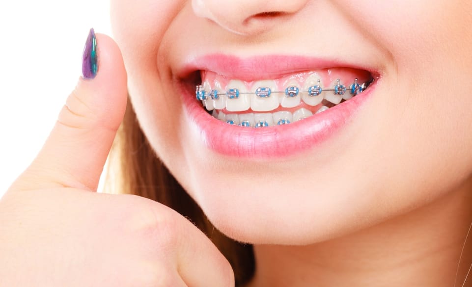 6 Reasons Why You Should Consider Invisalign Treatment For Orthodontic Treatment