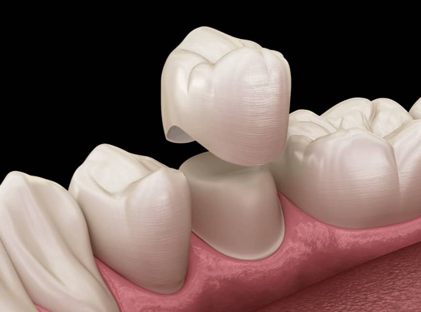 How Same-Day Dental Crowns Revolutionize Your Smile in a Single Visit