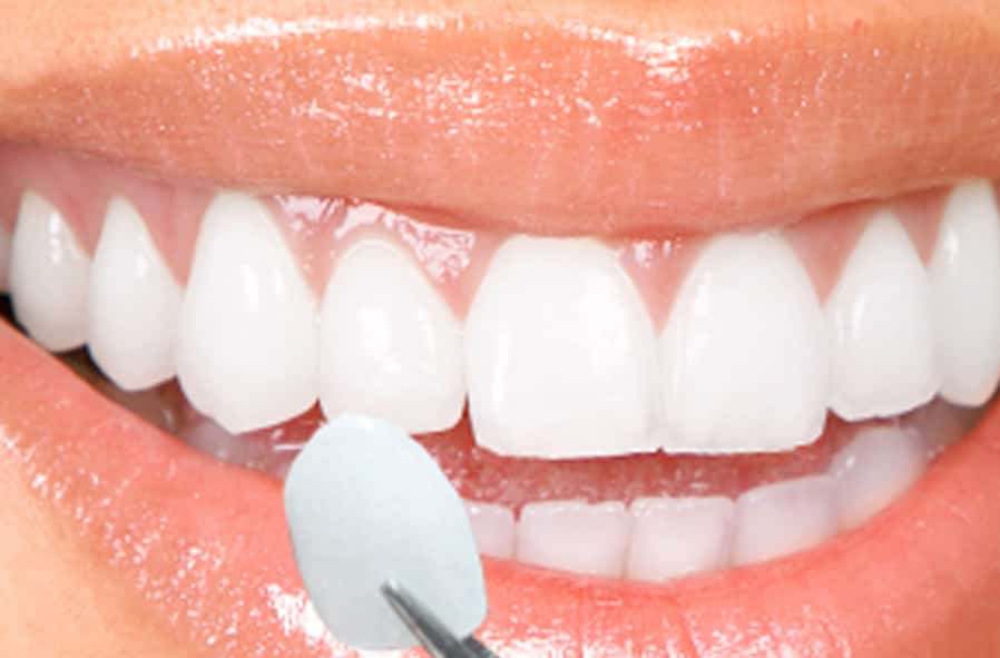 same-day dental crowns