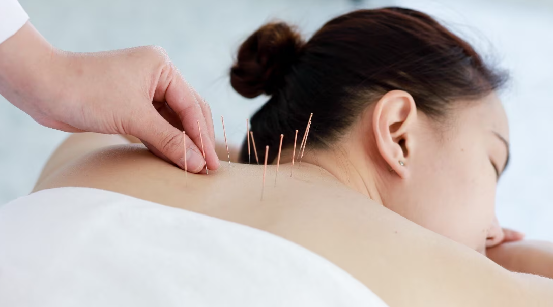 Acupuncture in Epsom