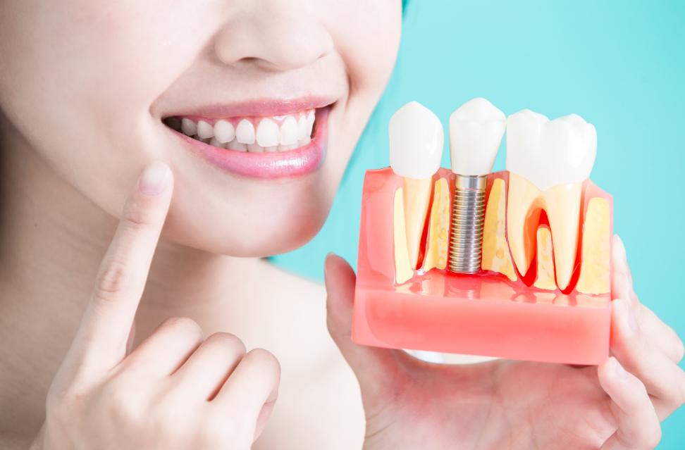 Benefits of Dental Implants in Newcastle: Why They’re the Best Solution for Missing Teeth