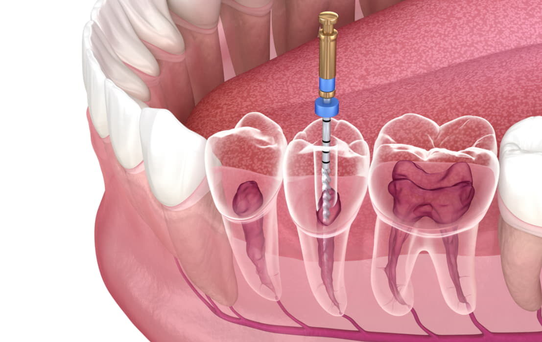 Why Root Canal Greensboro, NC is a Better Option than Tooth Extraction
