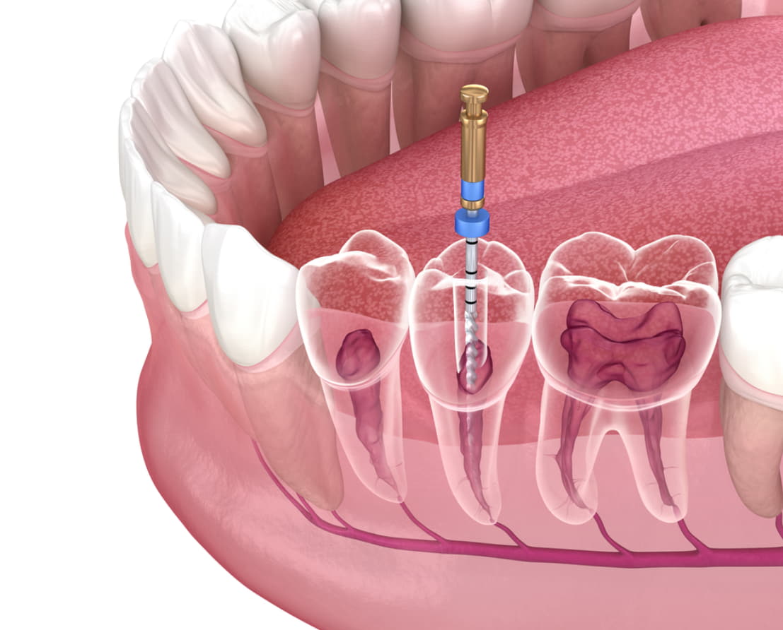 Root canal in Greensboro, NC