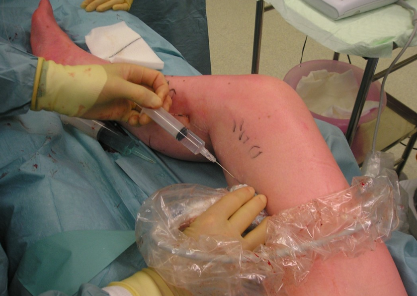 endovenous thermal ablation