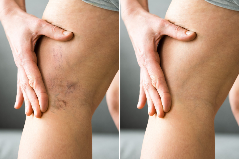 Flaunt Your Legs Again and Boost Your Confidence with Spider Vein Treatment