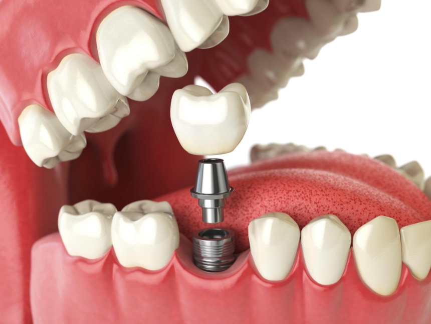 dental implants in Northern Rivers