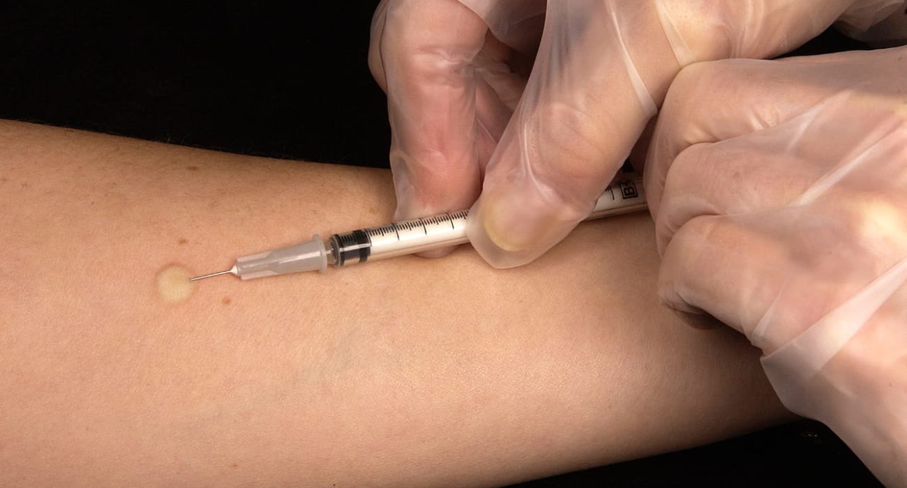 Unveiling the Importance of TB Skin Test