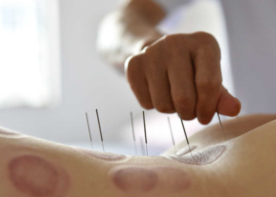 Chinese acupuncture