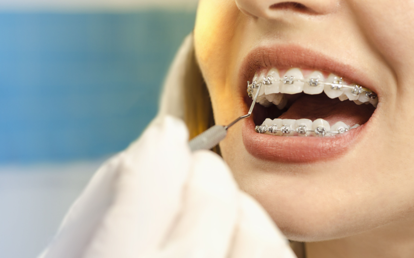 “Smile Confidently: Exploring the Benefits of Adult Braces in Victoria”