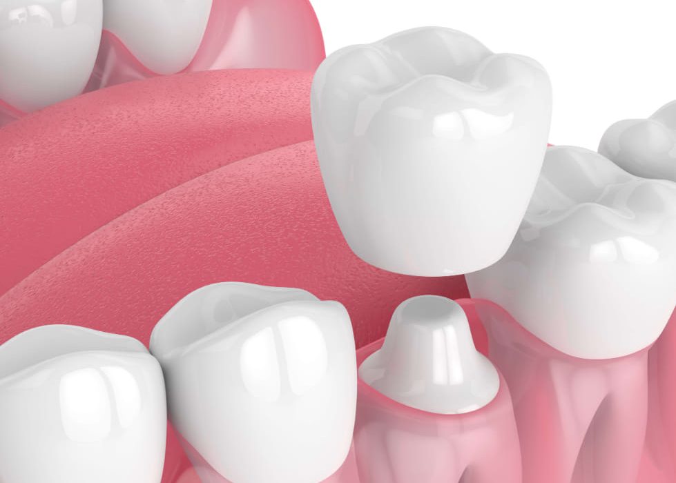 Experience Seamless Dental Restoration with One Day Crowns: A Time-Saving Solution