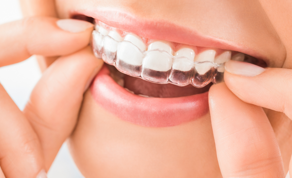 Invisible Aligners, Visible Results: Exploring the Benefits of Invisalign Treatment