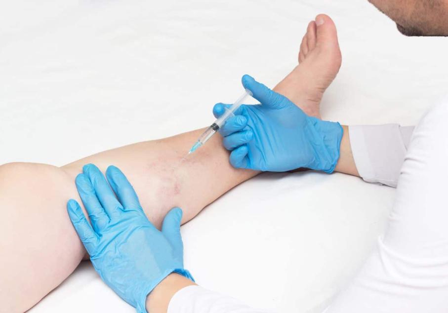 Vein Injection Sclerotherapy: A Painless Solution for Spider and Varicose Veins