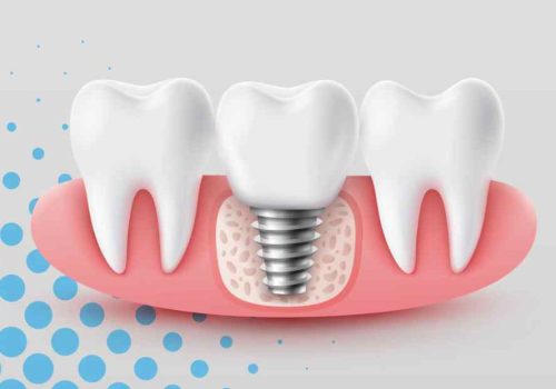 Navigating the Real Costs of Tooth Replacement: A Practical Guide to Budgeting for Permanent Dental Implants
