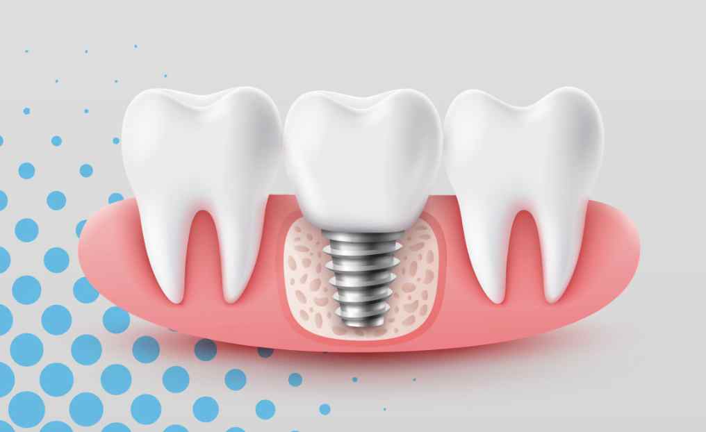 Navigating the Real Costs of Tooth Replacement: A Practical Guide to Budgeting for Permanent Dental Implants